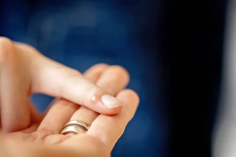 Kurzajki podolog czy dermatolog?